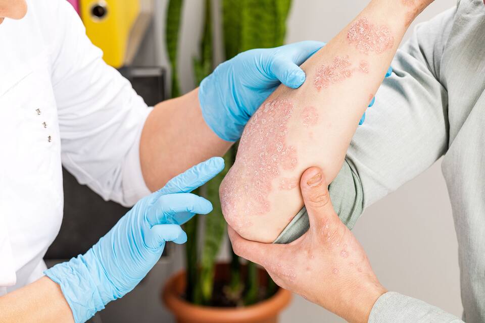 Solutions gérer le Psoriasis