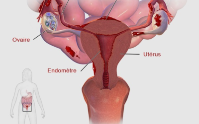 L’endométriose, le mal du siècle