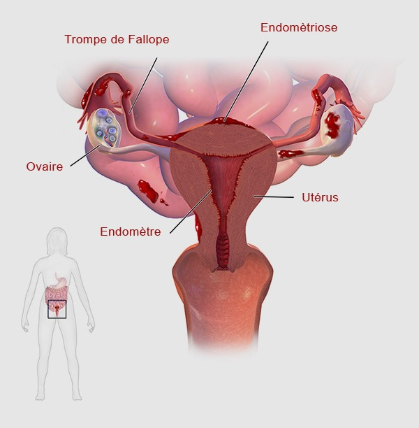 L’endométriose, le mal du siècle